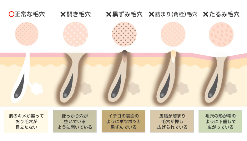 「毛穴」といっても症状はさまざま