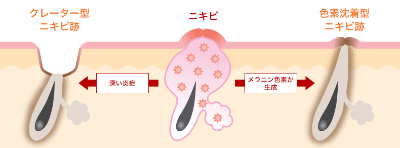 ニキビ跡の原因