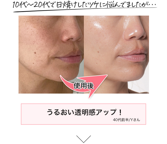 10代～20代で日焼けしたツケに悩んでましたが… 